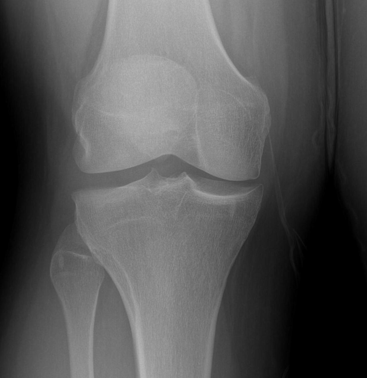 Discoid Meniscus Flattened Condyle Widened Joint Space